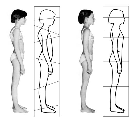 Die Abbildung oben zeigt ein Mädchen vor der ersten und nach der zehnten Rolfing® Sitzung. Die in den Umrisszeichnungen eingetragenen Achsen deuten die Ausrichtungen der einzelnen Körperblöcke an. Während die Achsen in der ersten Umrisszeichnung in unterschiedliche Richtungen zeigen, sind die einzelnen Körperblöcke nach den zehn Sitzungen wieder harmonisch ausgerichtet.